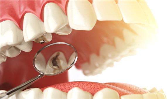 تأثیر عصاره رزماری و میخک بر باکتری‌های عامل پوسیدگی دندان