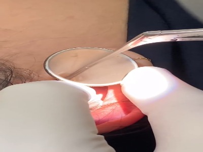 لحظه خارج کردن عنکبوت زنده از گوش خانم باردار بعد از پنج روز