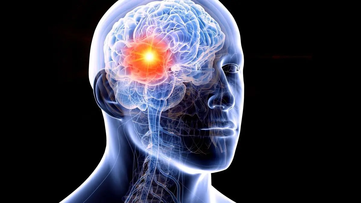 هوش مصنوعی جدید با تحلیل DNA می‌تواند ریسک سکته مغزی را پیش بینی کند