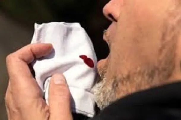۱۱ بیمار جدید مبتلا به سل در کاشان شناسایی شد